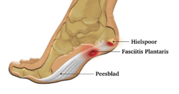 Wat is sale fasciitis plantaris